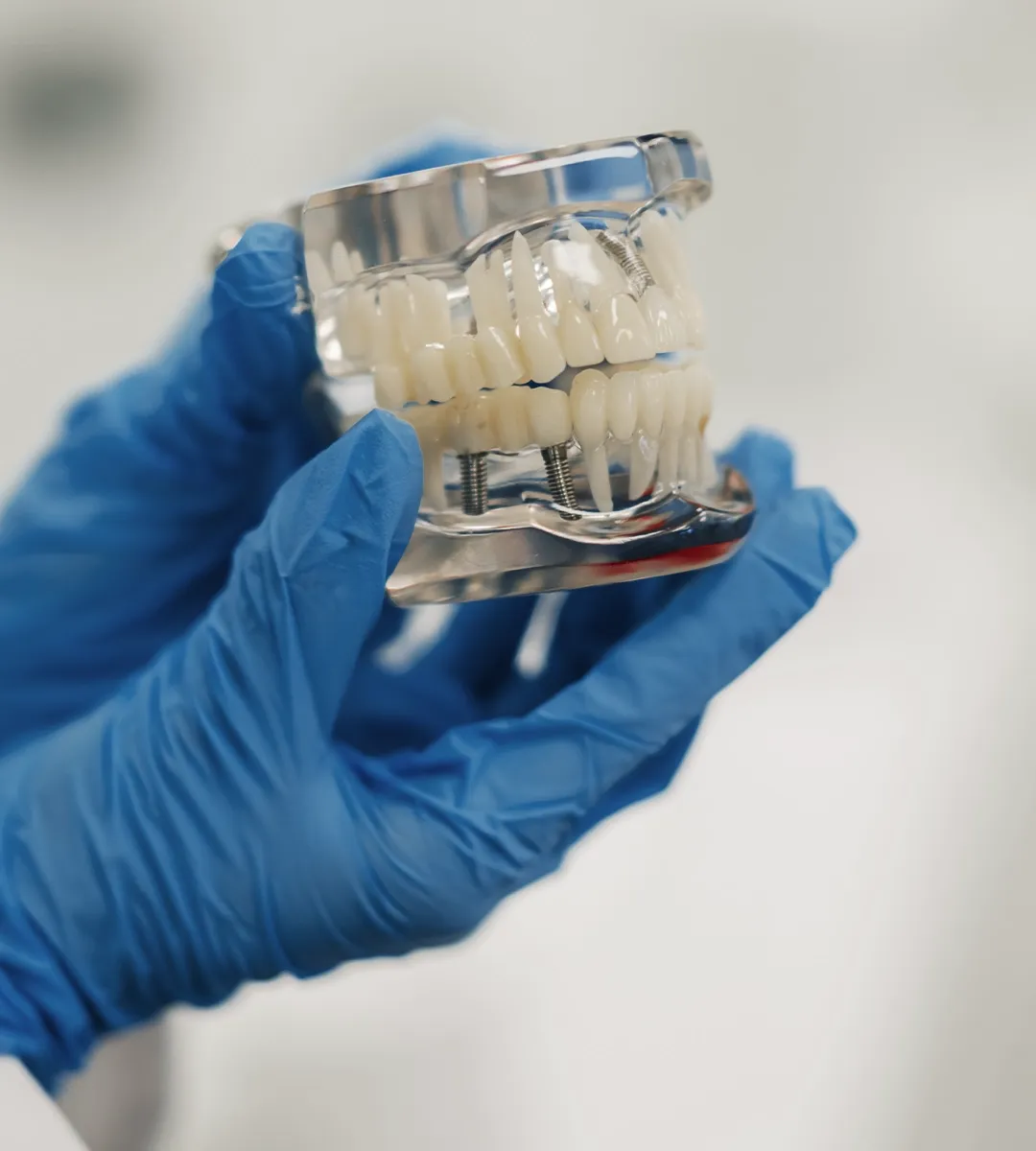 Modello di arcata dentale con impianti
